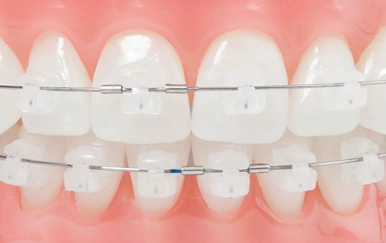 Ортодонтические дуги — изображение 3