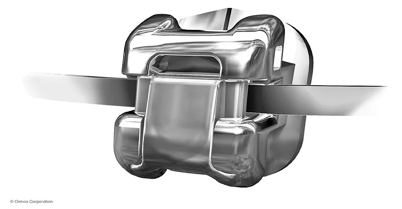 Брекеты Damon Q — изображение 3